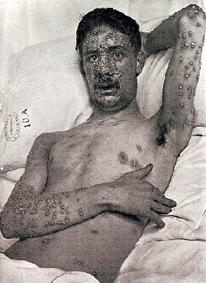 Patient with Smallpox